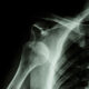 SHOULDER INSTABILITY – TREATING THE TRAUMATIC SHOULDER DISLOCATION