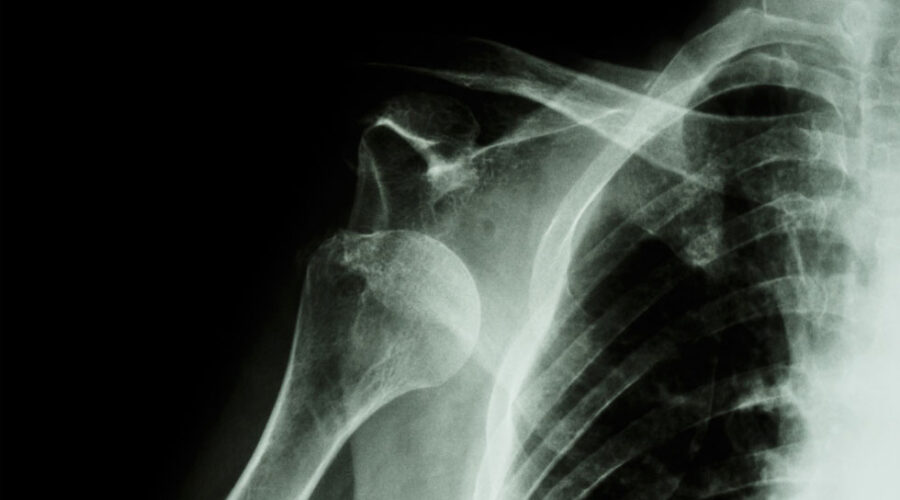 SHOULDER INSTABILITY – TREATING THE TRAUMATIC SHOULDER DISLOCATION